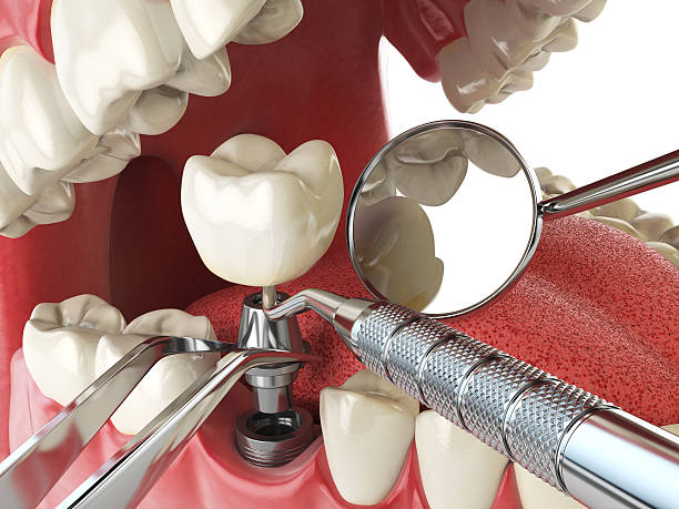 Best Emergency Dentist for Lost Fillings or Crowns in Calico Rock, AR